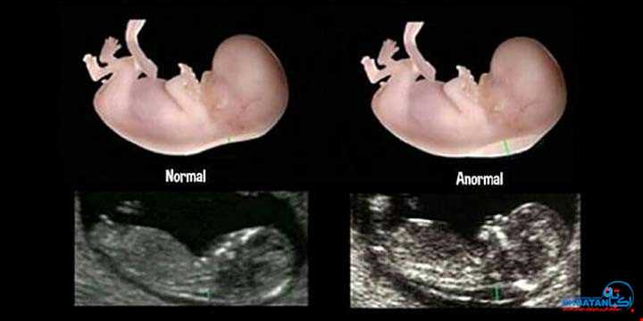 غربالگری سه ماهه اول بارداری (NT) | سونوگرافی و رادیولوژی دیجیتال اکباتان | دکتر بهنام غیاثوند