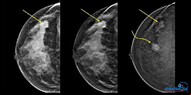 پیشگیری از سرطان پستان با غربالگری به موقع با ماموگرافی | سونوگرافی و رادیولوژی دیجیتال اکباتان | دکتر بهنام غیاثوند