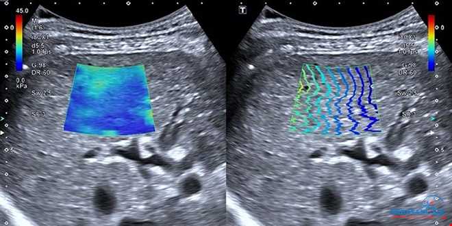 فیبرواسکن کبد در رادیولوژی اکباتان، تشخیص سریع و دقیق بیماری های کبدی | سونوگرافی و رادیولوژی دیجیتال اکباتان | دکتر بهنام غیاثوند
