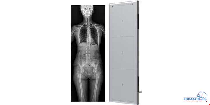 اسکولیوز و نقش رادیولوژی Total Spine در تشخیص و درمان | سونوگرافی و رادیولوژی دیجیتال اکباتان | دکتر بهنام غیاثوند
