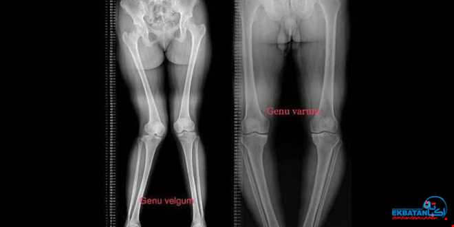 نقش رادیوگرافی الاینمنت (Three Joint View) در پا پرانتزی و پا ضربدری کودکان | سونوگرافی و رادیولوژی دیجیتال اکباتان | دکتر بهنام غیاثوند