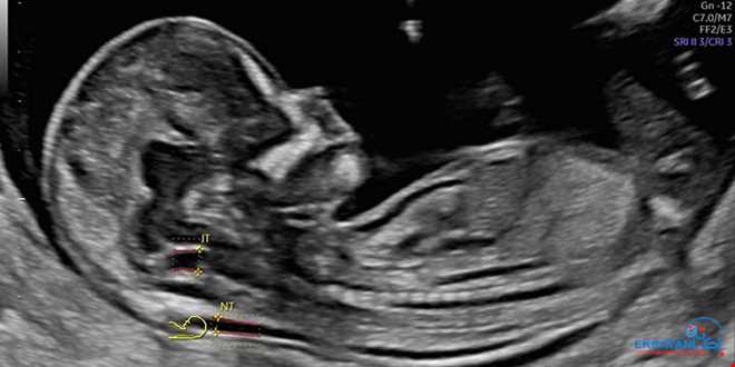 غربالگری NT، گامی مهم در ارزیابی سلامت جنین | سونوگرافی و رادیولوژی دیجیتال اکباتان | دکتر بهنام غیاثوند