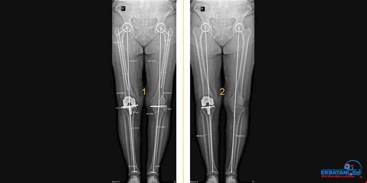 رادیوگرافی تری جوینت (سه مفصل)، استاندارد طلایی در تشخیص و درمان دقیق آرتروز زانو | سونوگرافی و رادیولوژی دیجیتال اکباتان | دکتر بهنام غیاثوند