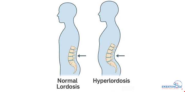 همه چیز درباره گودی کمر (هیپرلوردوز) | سونوگرافی و رادیولوژی دیجیتال اکباتان | دکتر بهنام غیاثوند