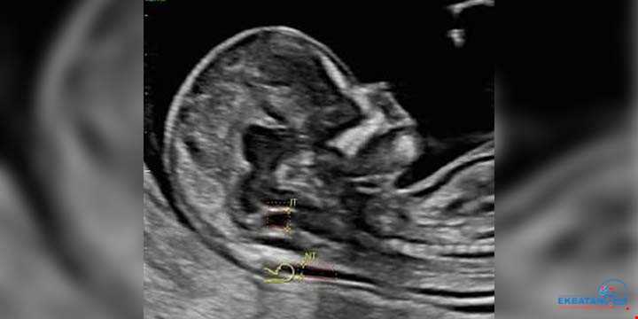 سونوگرافی NT چیست و چرا در سلامت جنین حیاتی است؟ | سونوگرافی و رادیولوژی دیجیتال اکباتان | دکتر بهنام غیاثوند