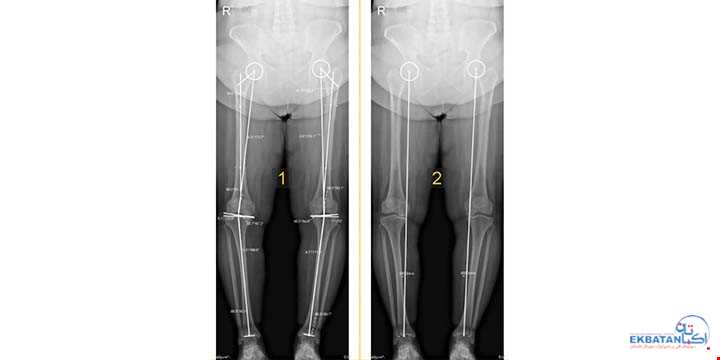 رادیوگرافی الاینمنت (تری جوینت) چیست و چه اهمیتی در آرتروز زانو دارد؟ | سونوگرافی و رادیولوژی دیجیتال اکباتان | دکتر بهنام غیاثوند