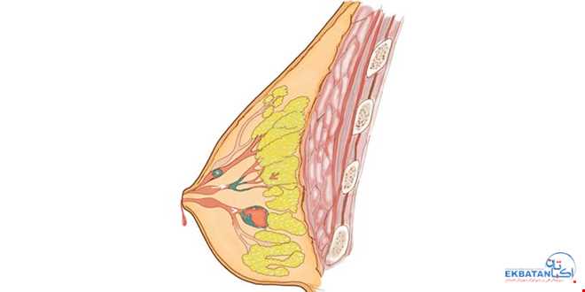 پاپیلوم داخل مجرای پستان ,Intraductal Papilloma | سونوگرافی و رادیولوژی دیجیتال اکباتان | دکتر بهنام غیاثوند