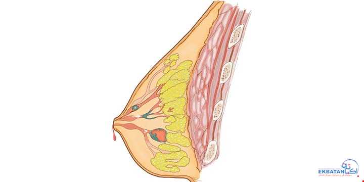 پاپیلوم داخل مجرای پستان ,Intraductal Papilloma | سونوگرافی و رادیولوژی دیجیتال اکباتان | دکتر بهنام غیاثوند