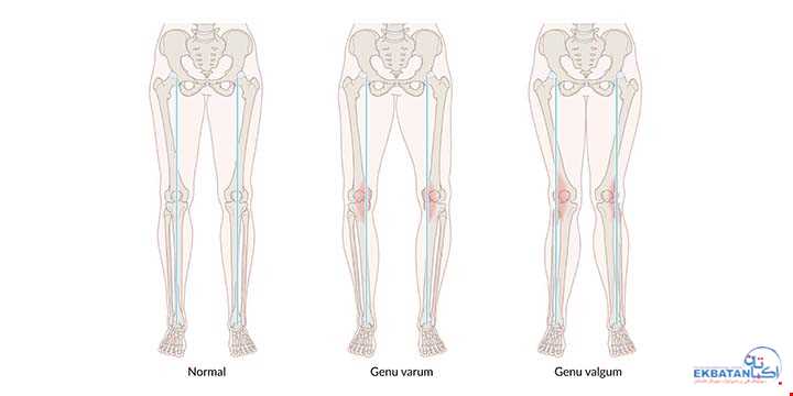 درمان پا پرانتزی و پا ضربدری در کودکان | سونوگرافی و رادیولوژی دیجیتال اکباتان | دکتر بهنام غیاثوند