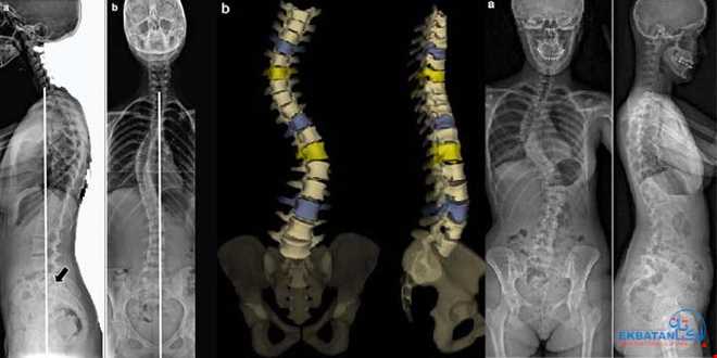 تصویربرداری کل ستون فقرات (Total Spine) در رادیولوژی اکباتان | سونوگرافی و رادیولوژی دیجیتال اکباتان | دکتر بهنام غیاثوند