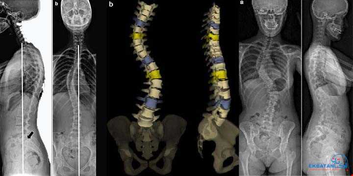 تصویربرداری کل ستون فقرات (Total Spine) در رادیولوژی اکباتان | سونوگرافی و رادیولوژی دیجیتال اکباتان | دکتر بهنام غیاثوند