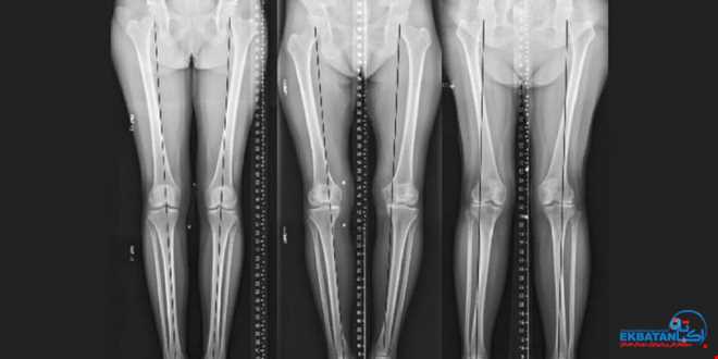 نقش رادیوگرافی الاینمنت (Three Joint View) در تشخیص، پیشگیری و درمان آرتروز و مشکلات زانو | سونوگرافی و رادیولوژی دیجیتال اکباتان | دکتر بهنام غیاثوند